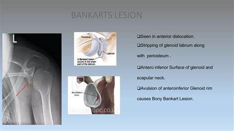 Shoulder Dislocation Types And Management Methods Of Reduction Ppt