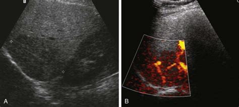 Benign Tumors Of The Liver Radiology Key