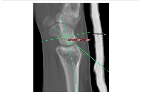 Measurement Of The Scapholunate Angle In The Sagittal Plane Download