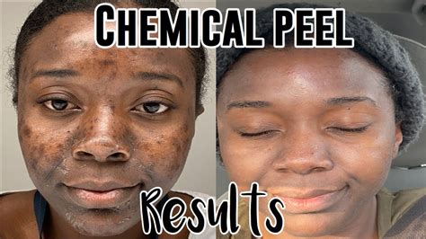 Chemical Peel Before And After Brown Skin See The Stunning Results