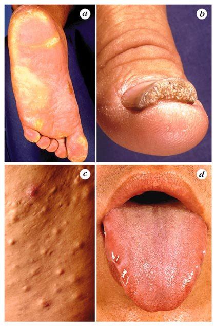 Clinical Features Of Pachyonychia Congenita Type 2 Observed In The