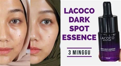 Skincare Untuk Menghilangkan Flek Hitam Dan Bekas Jerawat Bikin