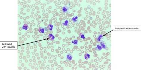 Peripheral Blood Smear Shows Numerous Neutrophils And Many Eosinophils