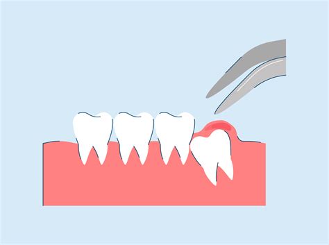 Emergency Wisdom Tooth Removal Everything You Need To Know Snow® Oral Care