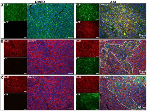 Expression Of Hepatic Malignant Markers In The Xenografts