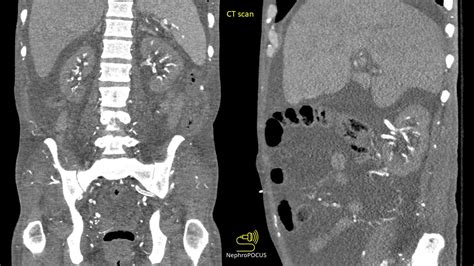 Prominent renal vascular calcifications – NephroPOCUS