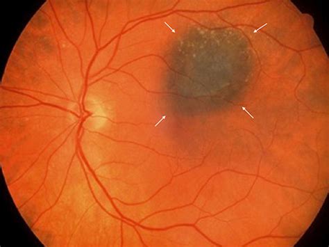 Choroidal Nevus With Lipofuscin