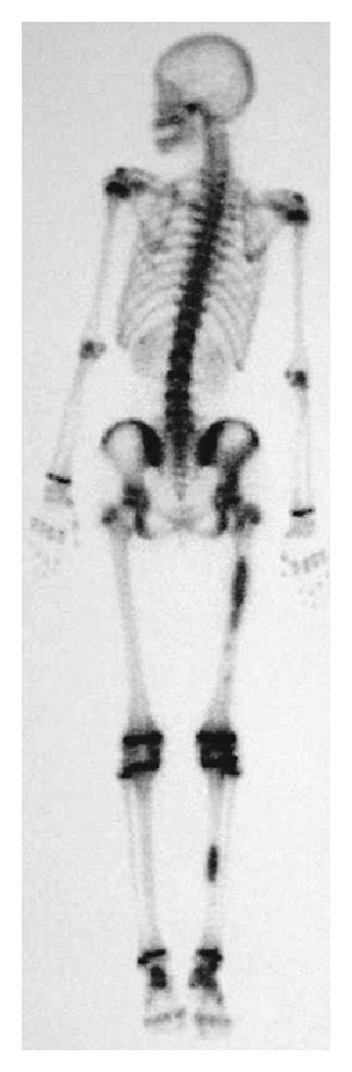 Technetium bone scintigram. Abnormal uptakes are shown in the diaphyses ... 