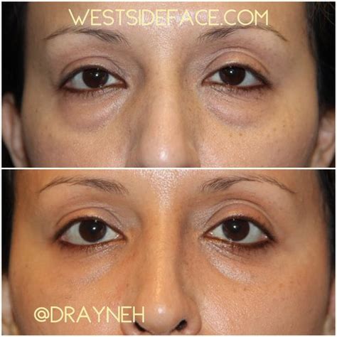Eyelid Lift