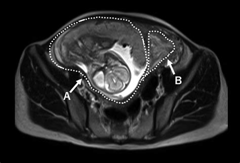 Magnetic Resonance Imaging Of A Complete Septate Uterus In A Case Hot