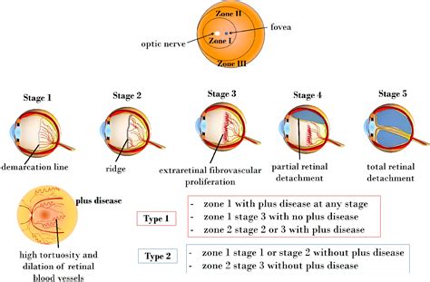 Figure 1 From Retinopathy Of Prematurity—targeting Hypoxic And Redox Signaling Pathways