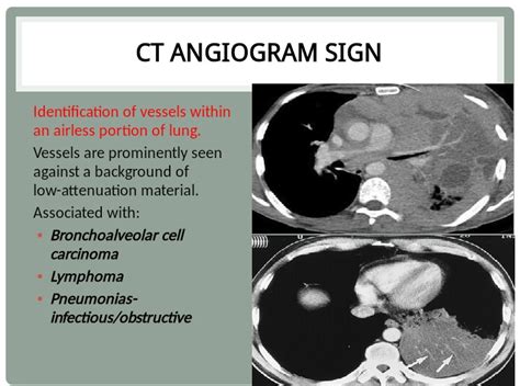 Chest Medicine Made Easy-Dr Deepu: CT angiogram sign