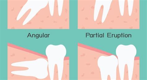 Wisdom Tooth Extractions Everything You Need To Know • Health Blog