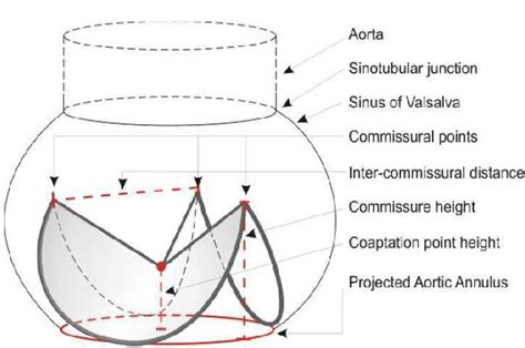 Schematic of aortic annulus measurements. | Download Scientific Diagram