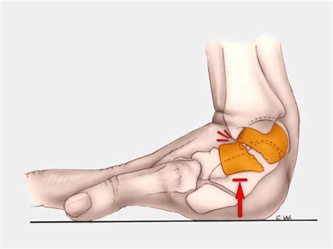 fracture du scaphoide carpien Institut Européen de la Main