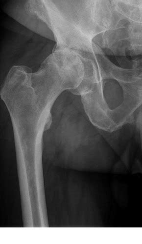 Minéralisation osseuse Traumatologie fracture ecc Flashcards Quizlet