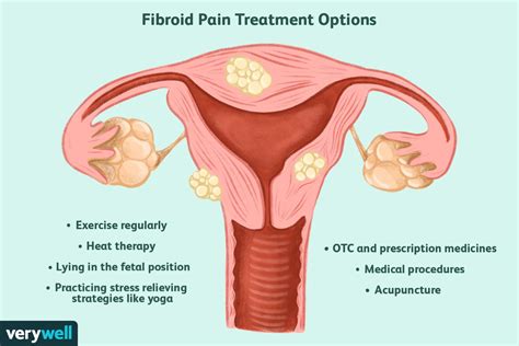 Uterine Fibroids Causes