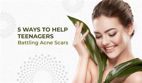 5 Strategies for Teenagers Fighting Acne Scars: Successful Acne Scar Treatment | by Acne Wiki ...