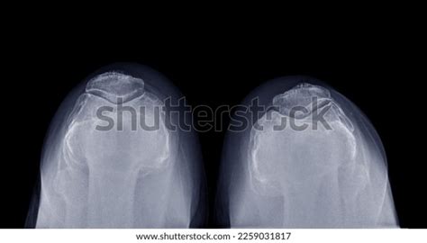 Xray Image Both Patella Fracture Diagnostic Stock Photo 2259031817 ...