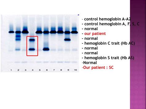 PPT - Hemoglobin Electrophoresis PowerPoint Presentation - ID:2372418