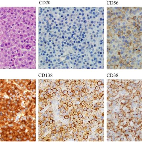 A Hematoxylin And Eosin He Staining Of The Tumoral Mass Biopsy B