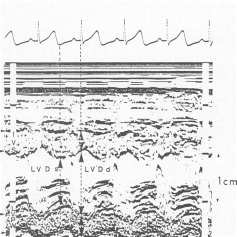 Measurements of the left ventricular dimension at end diastole (LVDd ...