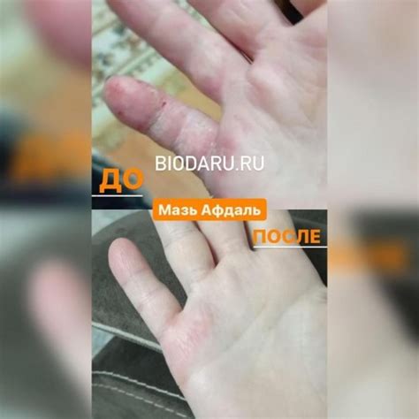Мединская Мазь Afdal Афдаль 10 гр от псориаза экземы и лишая купить с ...