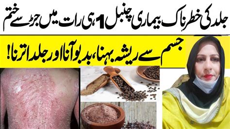 Chambal Ka Ilaj Chambal Kharish Ka Nuskha Psoriasis Skin Disease