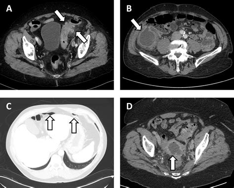 Is There Need For Routine Ct Colonography After Ct Verified