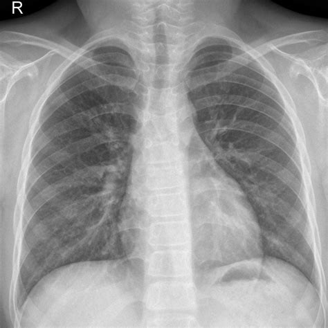 Chest X-Ray Images | Kaggle