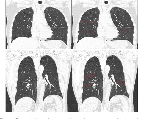 Figure From Automatic Segmentation Of Pulmonary Lobes Robust Against