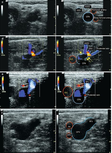 Examination Of The Great Saphenous Vein Radiology Key