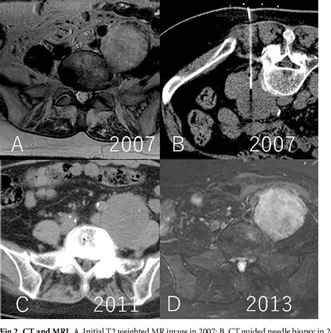 Figure From The Natural History Of Incidental Retroperitoneal