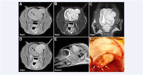 Figure From Magnetic Resonance Imaging Of Meningiomas Associated With