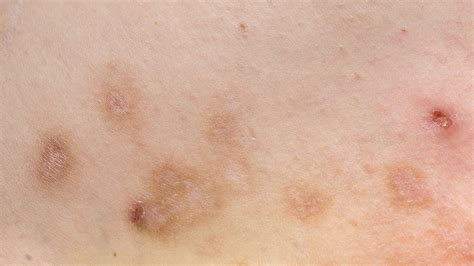 Dermatitis During Pregnancy