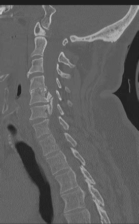 Cervical Osteophytes