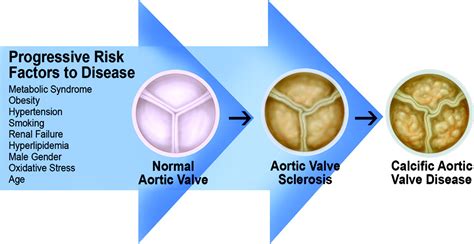 Calcific Aortic Valve Disease Not Simply A Degenerative Process