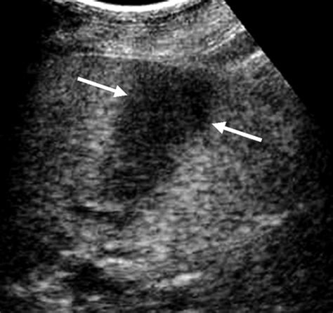 Contrast Enhanced Sonography Of The Spleen Ajr