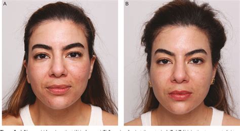 Figure 2 From Creating Lift In The Lower Face With Botulinum Toxin A