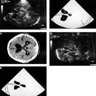 Brain atrophy. CT and TCS in a patient with Huntington's disease with ...