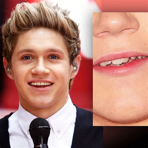 Before And After Braces Niall Horan