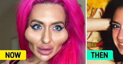 Woman With “biggest Cheeks In The World” Shows Off Her Rare Pre Surgery
