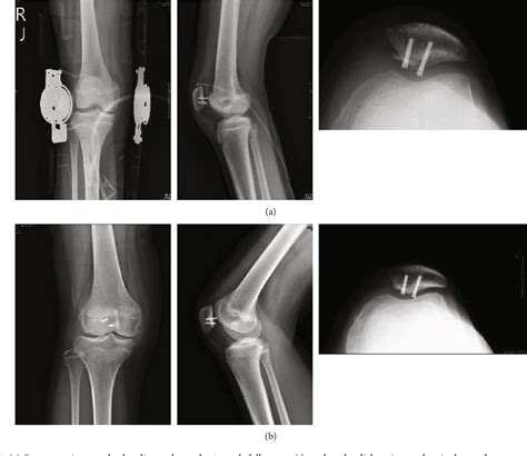 Figure 1 From Neglected Pediatric Osteochondral Fracture Dislocation Of