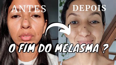 MELASMA TRATAMENTO Antes E Depois 4 Semanas Usando Esse Produto