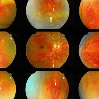 Predictive values of laboratory tests for the diagnosis of Ocular ...