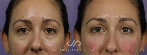 Juvederm Eyes Crescent