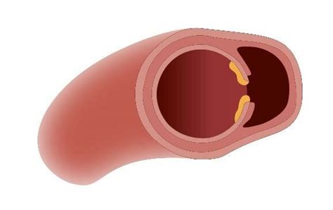 Penetrating Aortic Ulcer Image With Permission By Deutsches