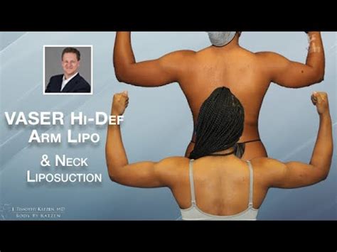 Vaser Hi Def Arm Liposculpture Plus Liposuction Of The Neck Youtube