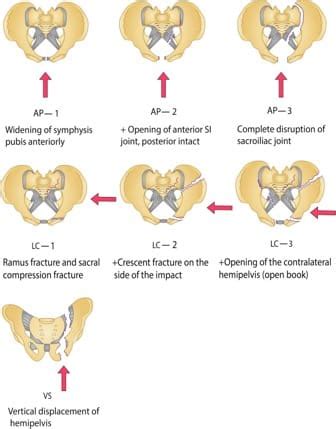 Pelvic Fractures Trauma Surgery - GMKA - Global Medical Knowledge Alliance