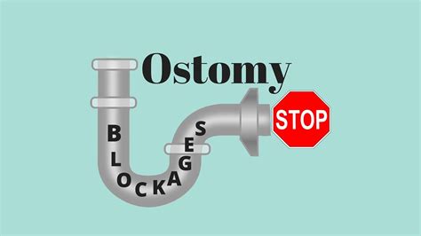 Dealing With Ostomy Blockages Ostomy Care Tips Ostomy Diet Ostomy